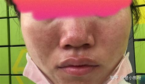 鼻子红怎么办|红鼻头必看：治愈酒糟鼻（草莓鼻）的全过程！